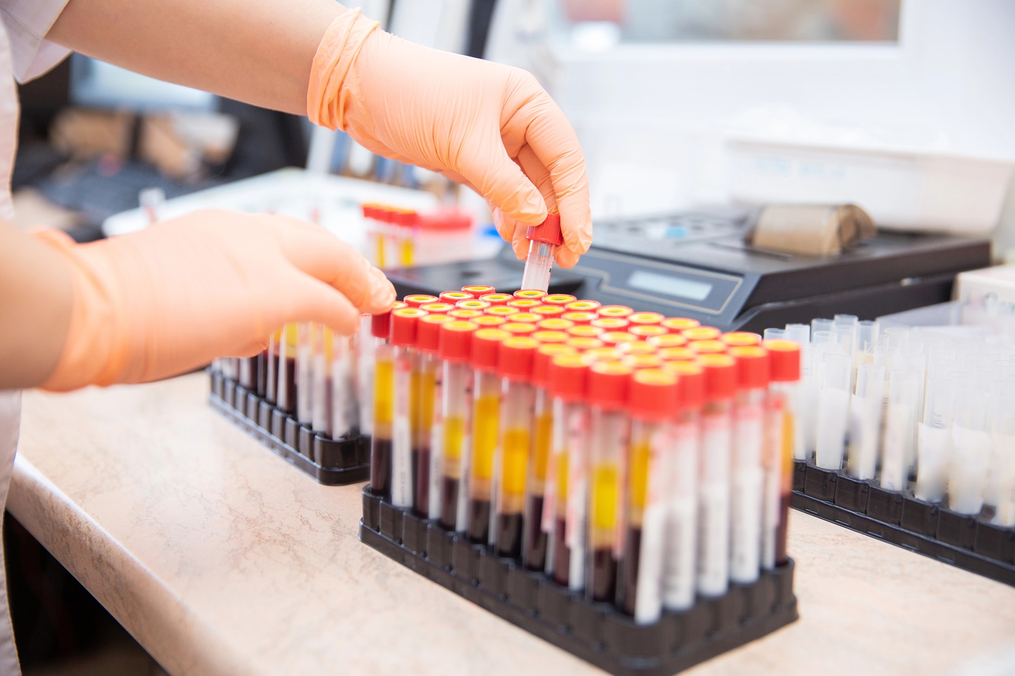 餐桌“刺客”拉高肿瘤指标